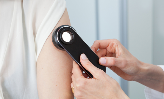 Melanoma: Not Just Skin Cancer