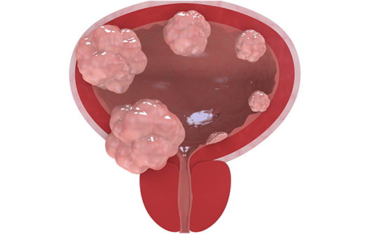 Understanding Bladder Cancer