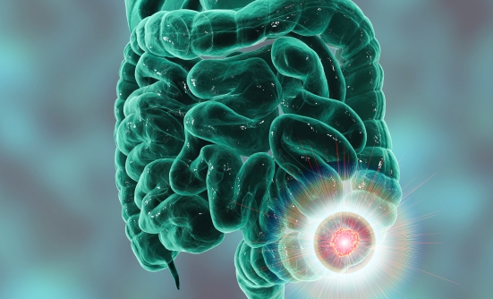 What Is the Best Way to Screen for Colorectal Cancer?