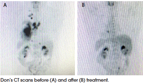 Don’s CT scans from before and after 